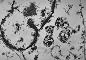 F,49y. | phagocytosed microbes - purulent meningitis